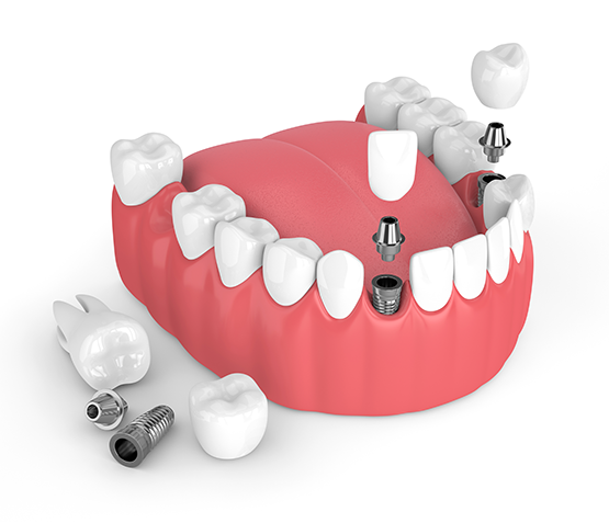 Dental Implants Olympia WA